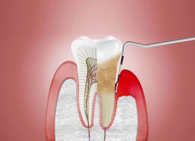 Periodontal küretaj